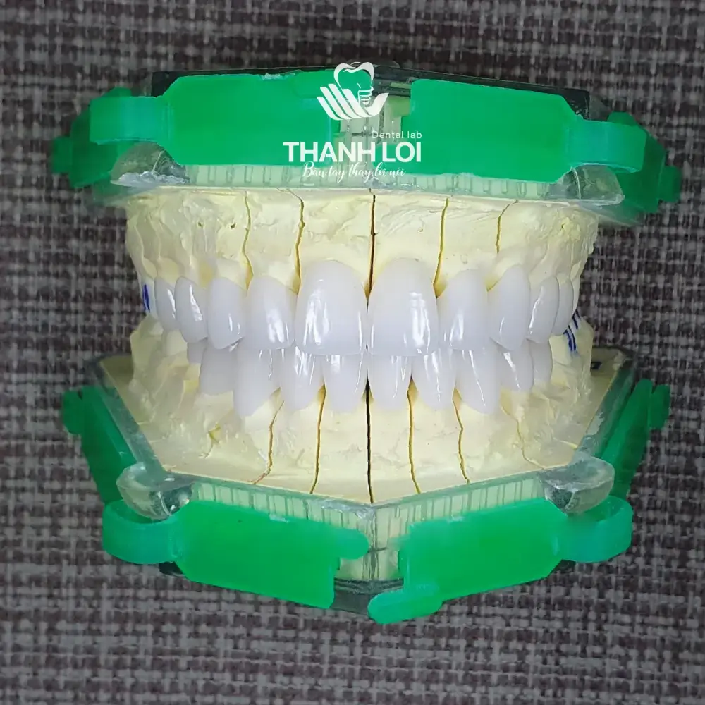 Phục hình Zirconia toàn hàm trên mẫu khớp cắn