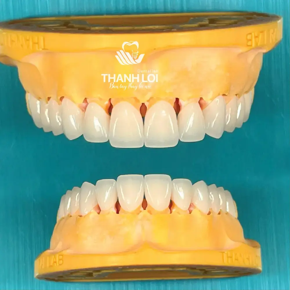 Cầu răng Zirconia trên mẫu in 3D